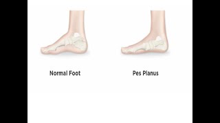 Ushtrime për shputën e sheshte(pes planus)