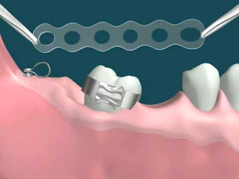 Dental Video of Molar Uprighting with Implants