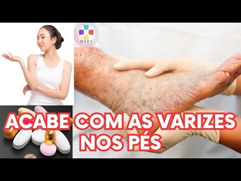 Sofre com as varizes nos pés ??? Assista esse vídeo !!! #varizessemcirurgia #varizes #varizesnospes