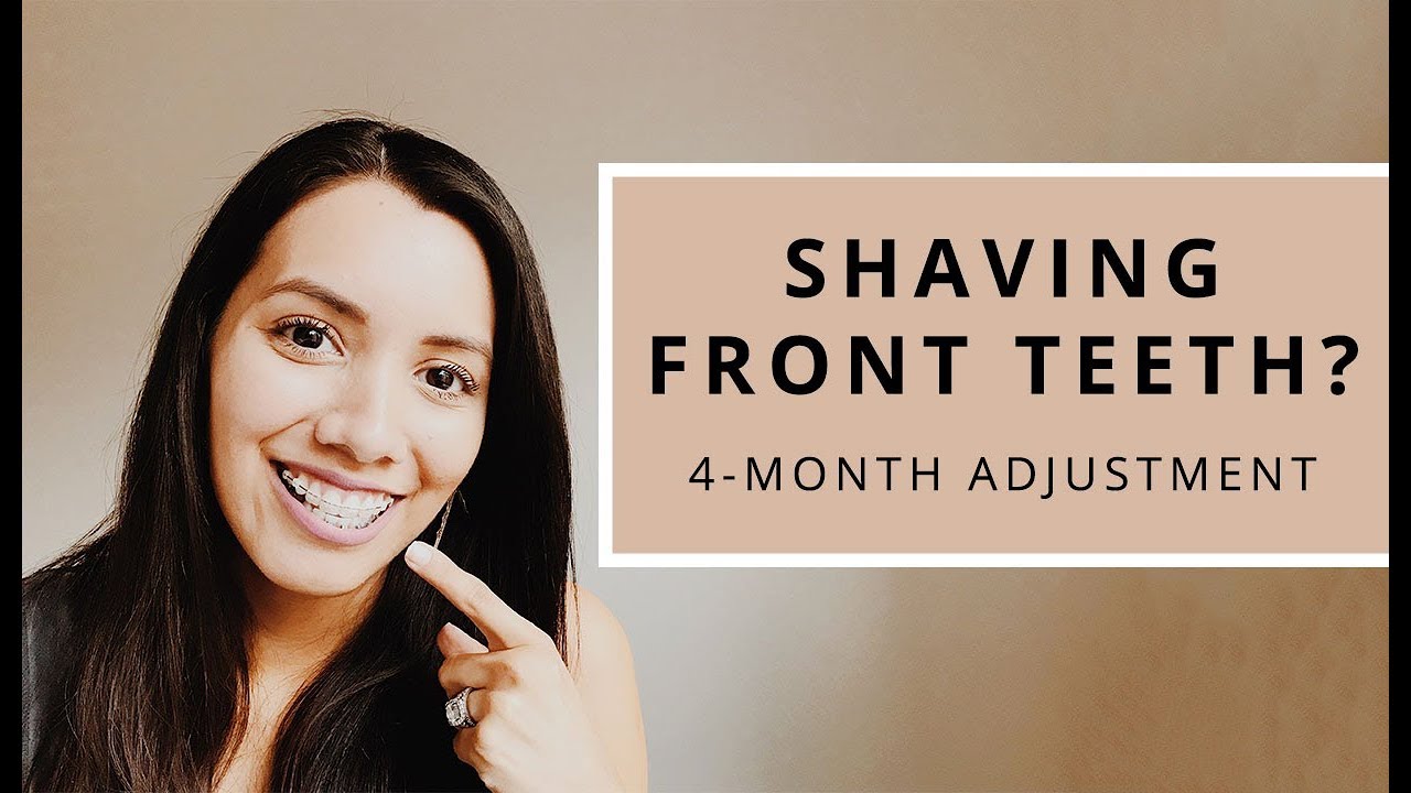 SHAVING FRONT TEETH? 4 month adjustment YouTube