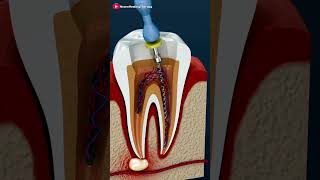 Root Canal Treatment #shorts