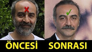 Saç Ektiren ve Protez Saç Kullanan Ünlüler (Öncesi - Sonrası)