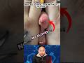 Abscess Extraction Without Gloves?! 😳 #shorts