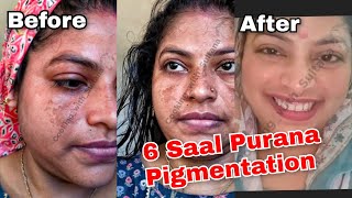 6 Saal purana Pigmentation KHATAM | Cooking with Sultana 