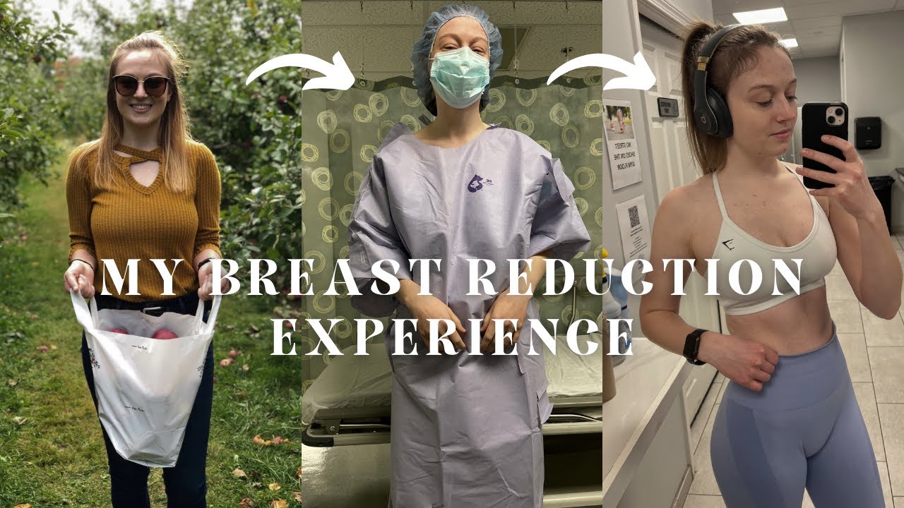 Мне сделали уменьшение груди — вот мой опыт! | Адрианна Б.