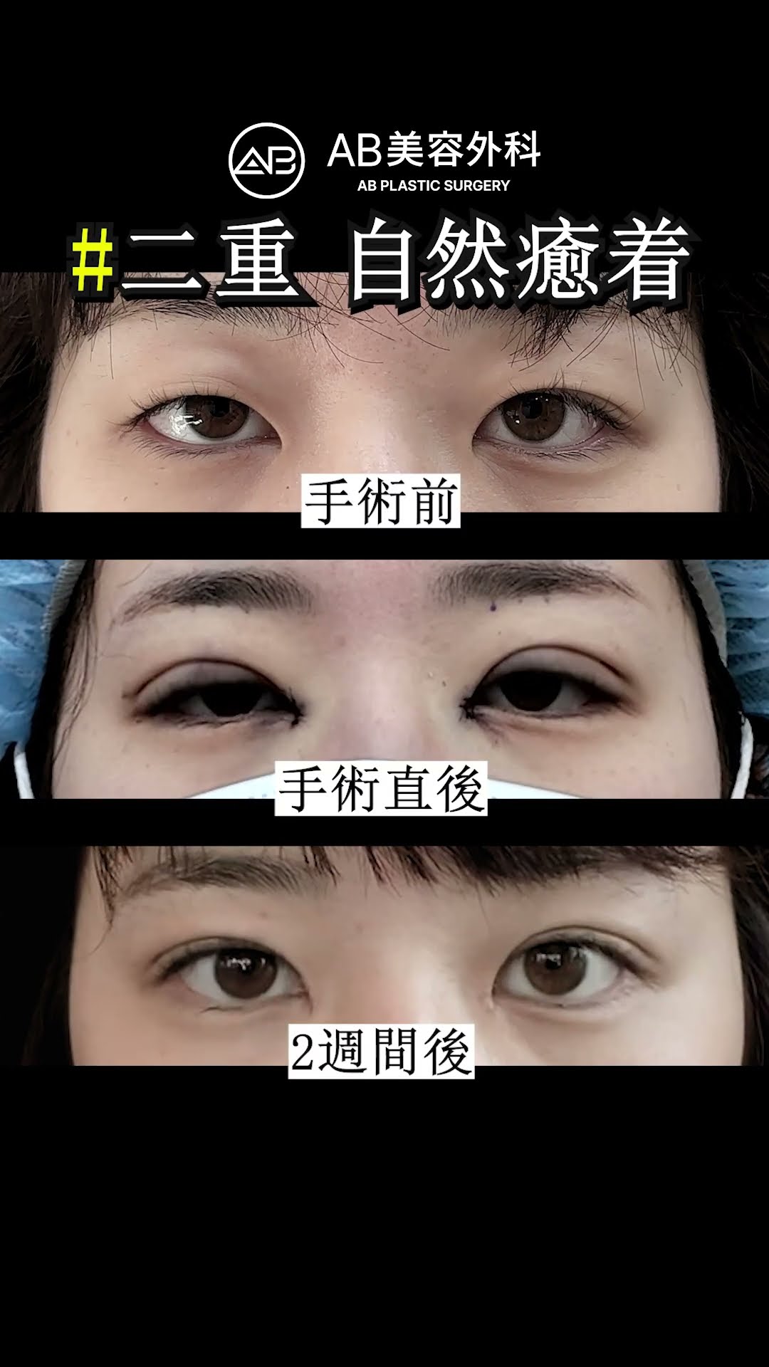 2週間ですっきり！自然癒着の手術後経過！ | AB美容整形