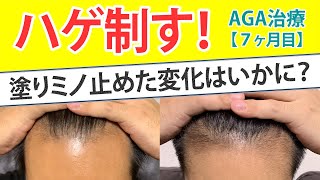 【AGA治療・薄毛治療体験レポート7ヶ月目】薄毛に悩む30代40代男性向け『塗りミノを止めての変化』