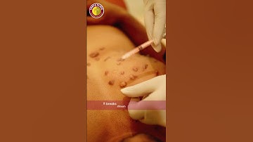 Keloid Removal Without Surgery | Vanya Clinic | Dr. Anil Kumar Kaler