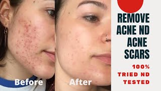 How to get rid of acne and acne scars in just 3 days