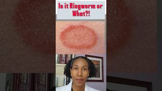 This Is Not Ringworm Ringworm Cream Wont Work