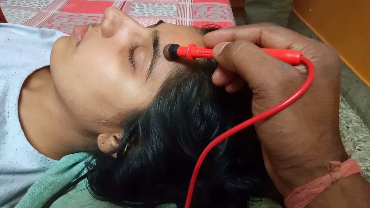 Head injury Bell's palsy