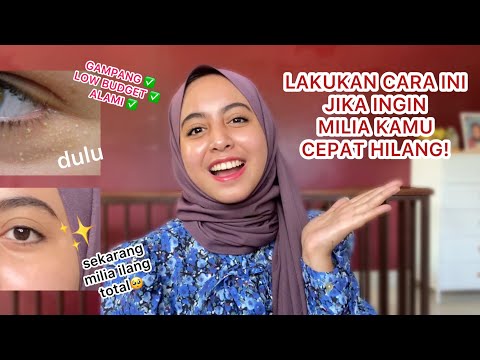 Video: Cara Menyingkirkan Milia: Apakah Home Removal Aman?