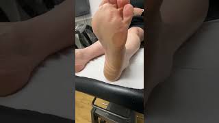 Dive Into The World Of Podiatry! Witness A Thick Forefoot Callus Removal By An Aussie Pro!
