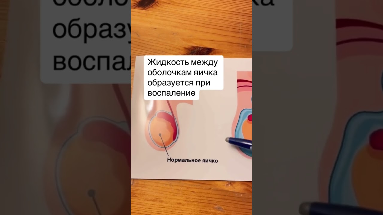 Причина гидроцеле – воспаление яичка
