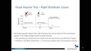 ICS Impulse vHIT: Introduction and overview of underlying physiology