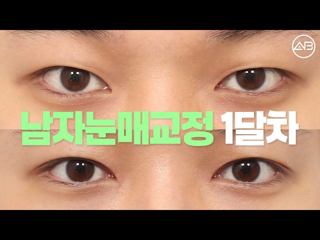 자연스러운 속쌍으로 매서운 짝눈 교정 | 에이비성형외과