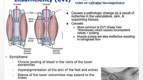 Ch 24 Pt 1 video Vessels, Atherosclerosis, MI and heart layer disorders - DayDayNews