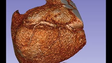 Coronary arteries volume rendering in Slicer 3D