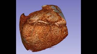 Coronary arteries volume rendering in Slicer 3D