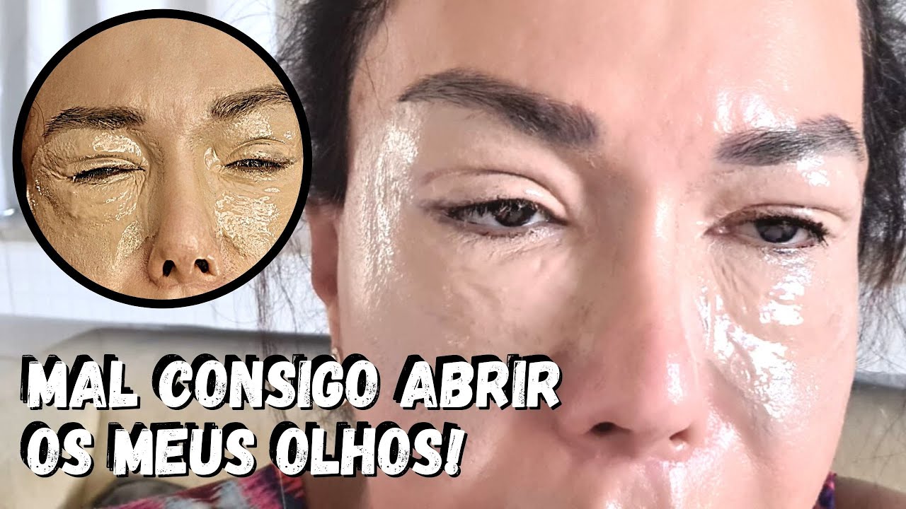 Peeling de Fenol: Minha Experiência e Resultados Surpreendentes! 😱✨- JOANNA MARIA
