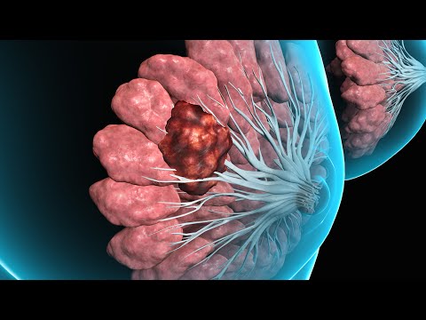 Breast Tissue Biopsy