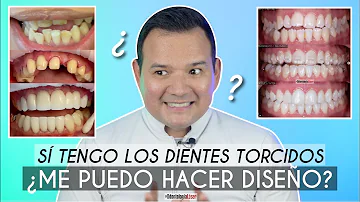 ¿Las carillas arreglan los dientes torcidos?