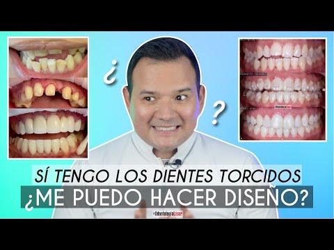 Video: ¿Pueden las carillas arreglar los dientes torcidos?