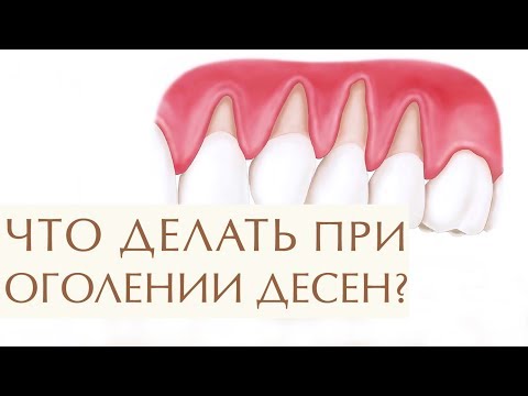 Видео: Как предотвратить опускание десен: 10 шагов (с иллюстрациями)