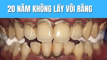 Có nên lấy cao răng hay không, 20 năm không lấy vôi răng có ảnh hưởng gì không | Nha Khoa Smile HT