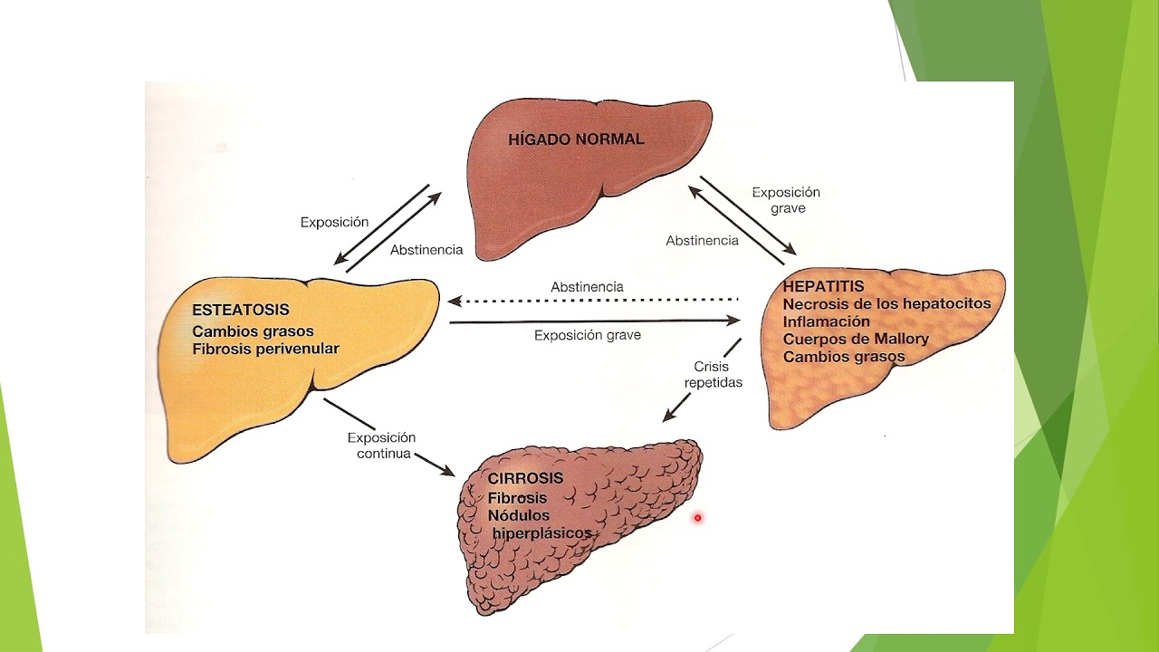 Hepatopatía alcohólica