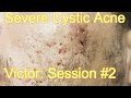 Severe cystic acne  victor session 2