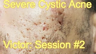 Severe Cystic Acne - Victor: Session #2