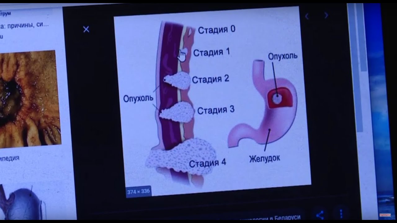 Язва или рак? / Здравствуйте
