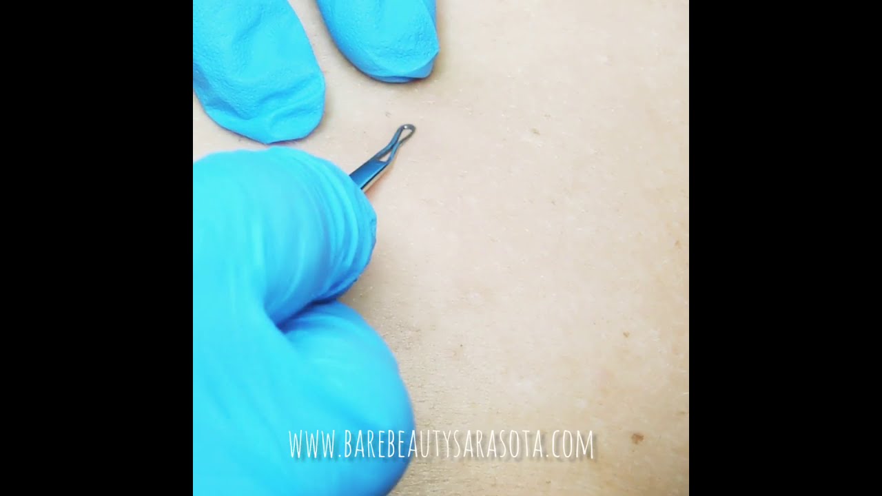 Back Facial Body Acne Treatment Blackhead Extractions at Bare