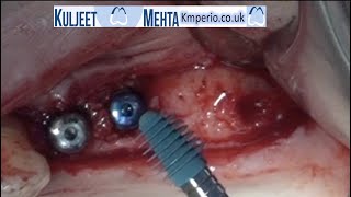 Dental Implant Surgery-Upper premolars & Molar by Dr Kuljeet Singh Mehta-Periodontist 11,028 views 2 years ago 12 minutes, 39 seconds