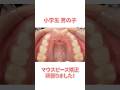 ワイヤーよりマウスピース矯正したい方必見!#インビザライン #さいとう矯正歯科 #歯列矯正