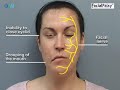 Understanding Facial Palsy