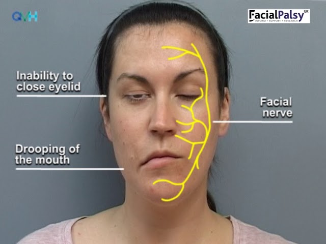 Facial / Bells Palsy Therapy TENS Unit for Home Use Tropical
