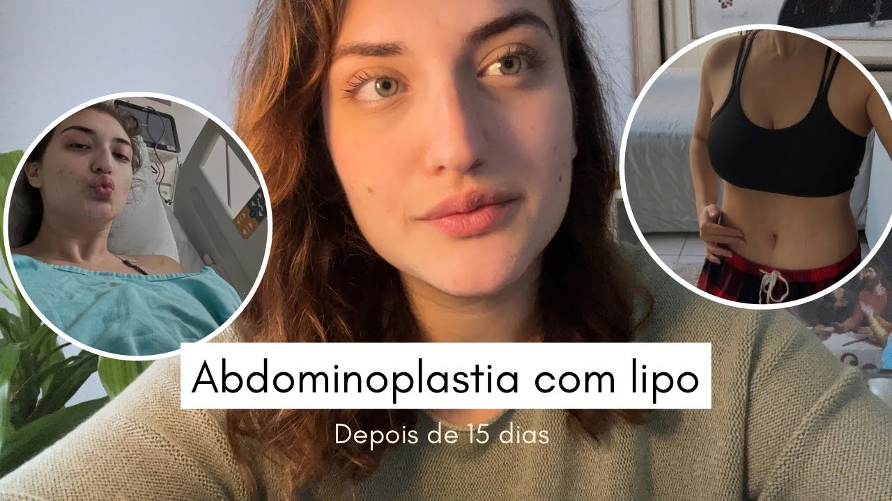 Abdominoplastia com lipo diário #02 minha barriga depois de 15 dias de ...