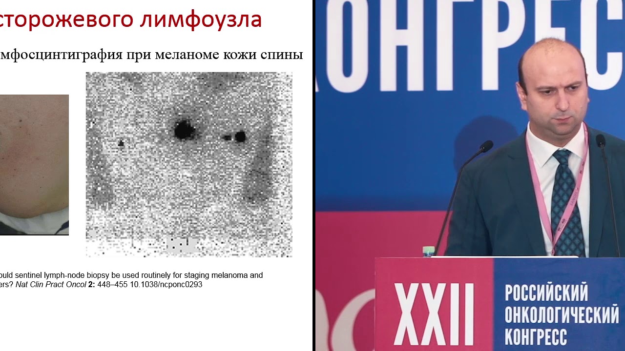 Лимфодиссекция после биопсии сторожевого лимфоузла. Барышников К.А.