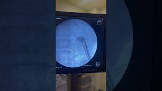 Keyhole surgery for renal stone #doctor #education #urology #pcnl