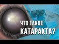 Что такое катаракта? Симптомы катаракты. Лечение катаракты в Москве.