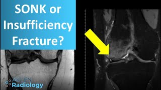 Why Spontaneous Osteonecrosis of the knee should not be used anymore