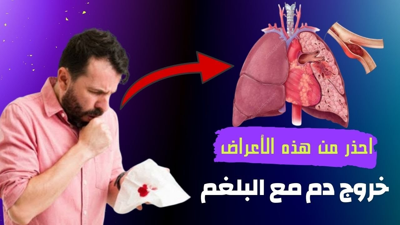 أسباب خروج الدم مع البلغم و هل يدل على مرض خطير ؟