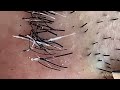 【Plucking facial hair】ずっと見ていられる泰然のヒゲ抜き 2023.4.14(頬ヒゲからアゴヒゲ抜き)【Pull out the beard】