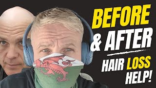 TESTING Hair System In EXTREME WEATHER | Before \& After | Hair Loss To Hair In Minutes UK