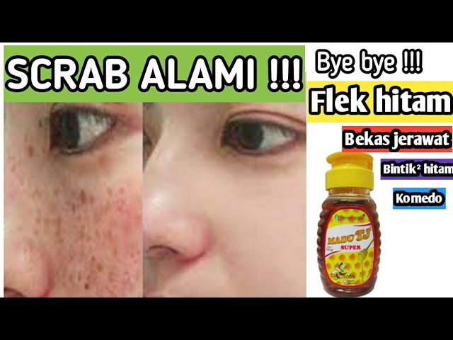 Cara Menghilangkan Flek Hitam Noda Hitam Komedo Bekas Jerawat Dengan Scrab Bahan Alami Dian W Sari Youtube