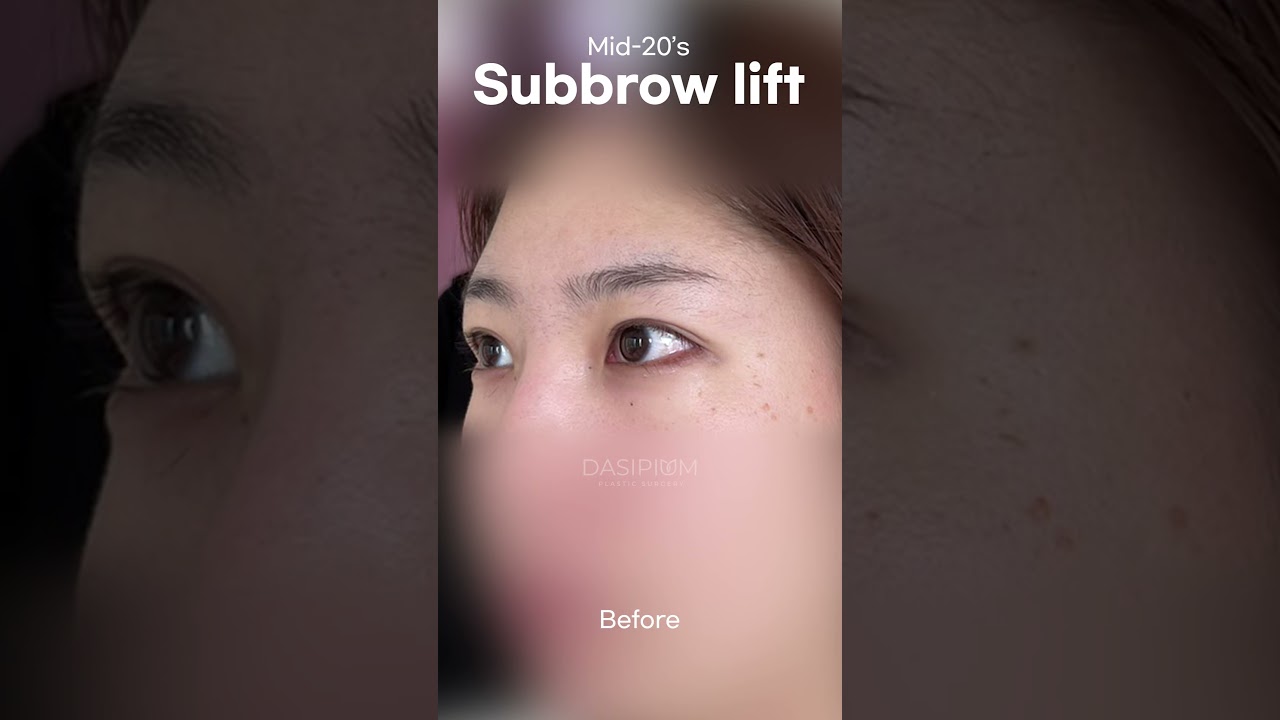 Subbrow lift 