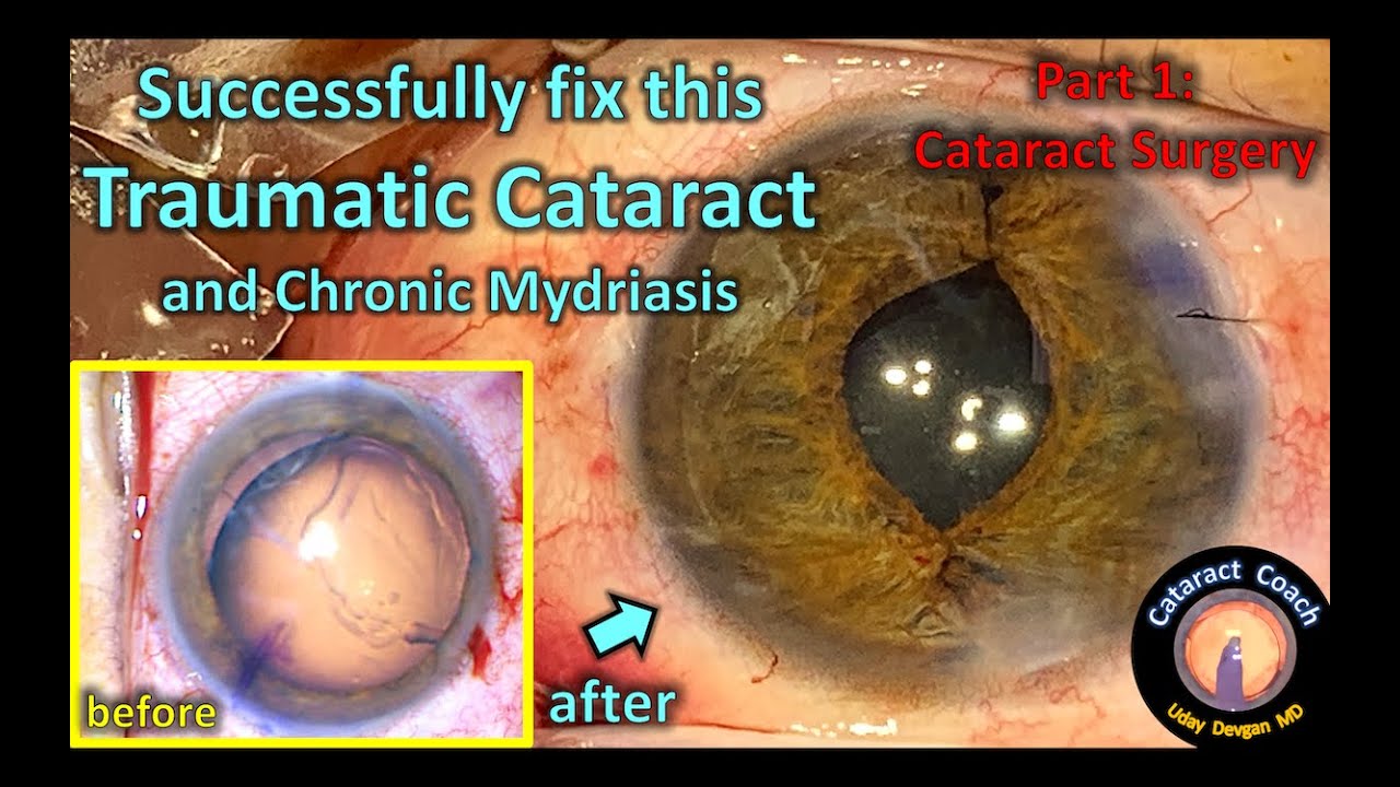 Cataract surgery of a traumatic cataract with zonular loss and iris