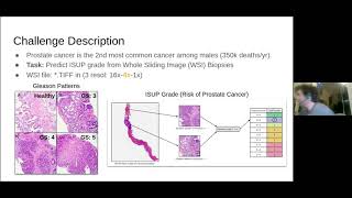 Celebrity Kaggle meetup: Prostate cANcer graDe Assessment (PANDA) Challenge Wealth